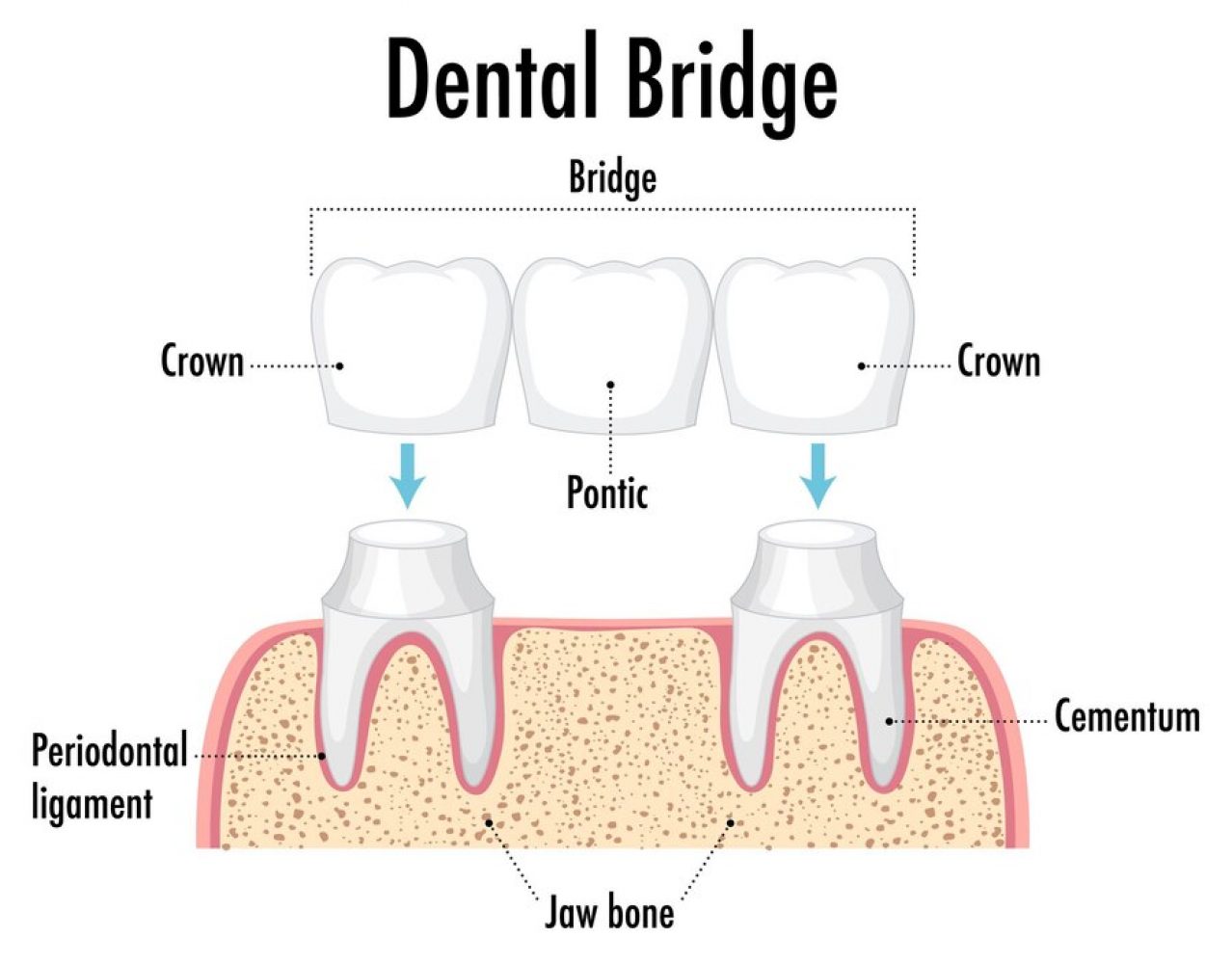 infographic-human-dental-bridge-white-background_1308-93628