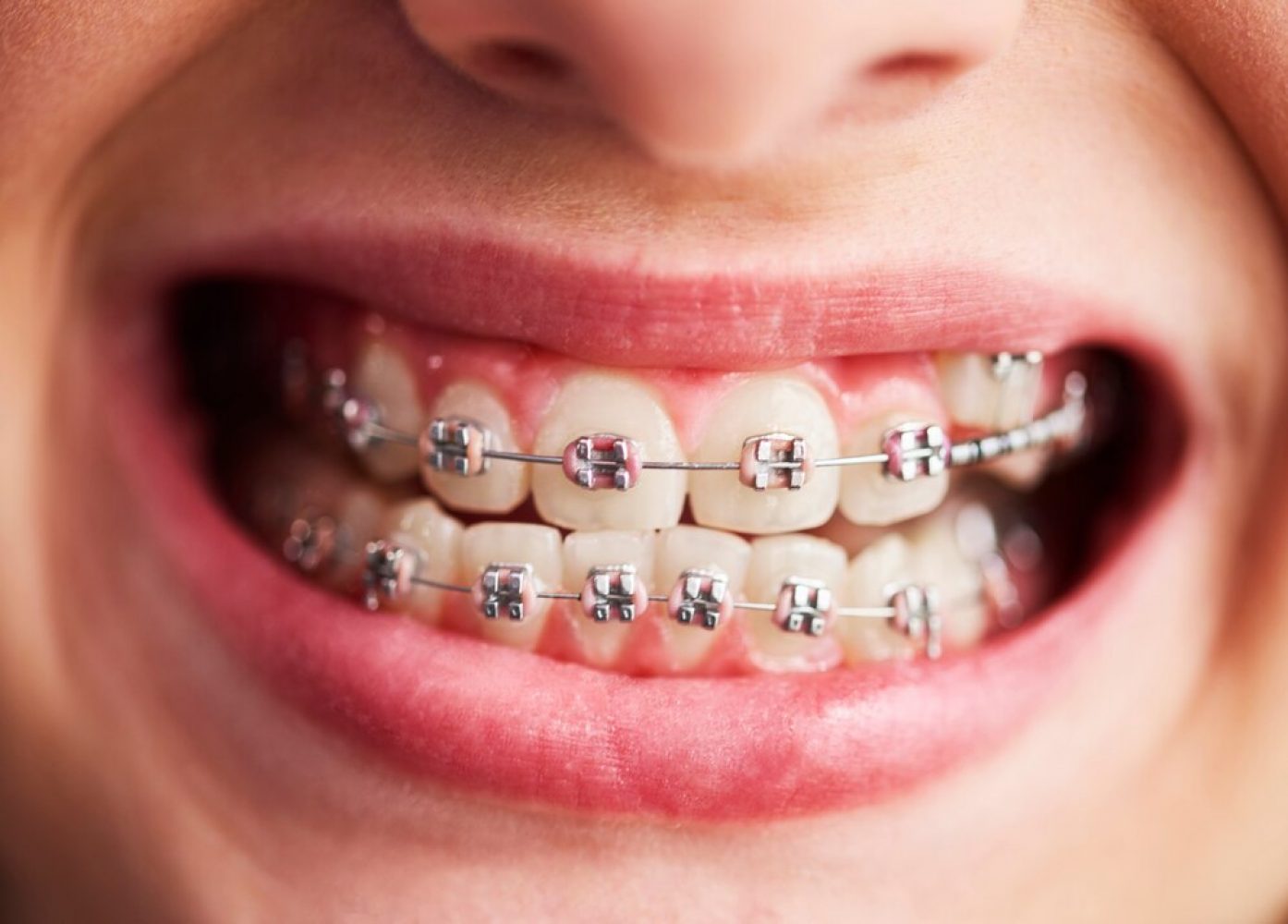 shot-child-s-teeth-with-braces_329181-17722